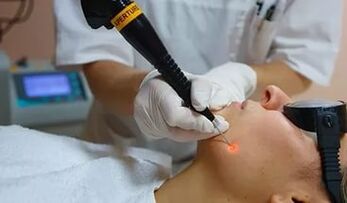 Efektīva procedūra papilomas noņemšanai uz sejas ar lāzeru