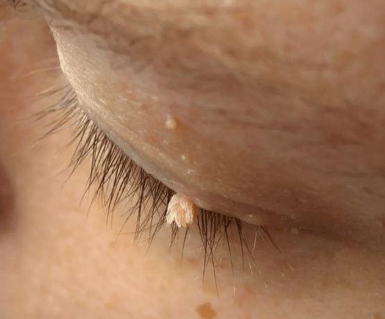 Filma Papillomas