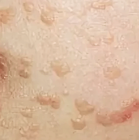 Plakanas papilomas