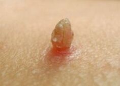 Asa papiloma