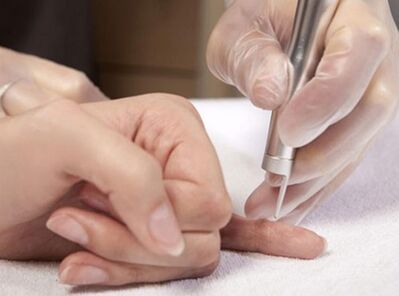 Lāzerterapijas veikšana