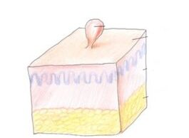 kā atbrīvoties no papilomas uz ķermeņa