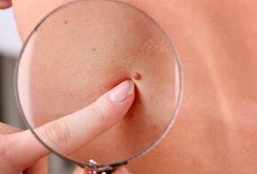 papilomu parādīšanās iemesli cilvēka ķermenī