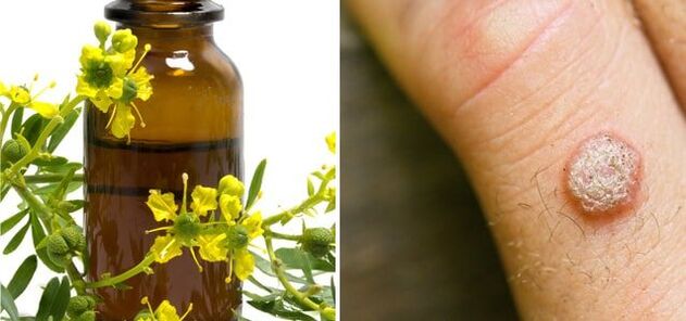 kārpu ārstēšana ar farmaceitisko strutene
