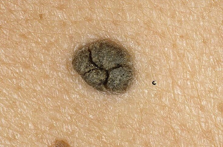 keratoma uz ķermeņa ādas